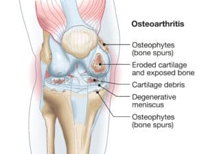 Accurate medically illustration showing knee joint osteophytes, erodet cartilage, exposed bone and degeneration