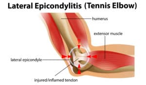 Lateral Epicondylitis or tennis elbow illustration